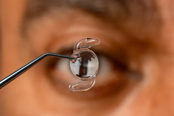 An intraocular lens held on forceps in front of a patient’s eye